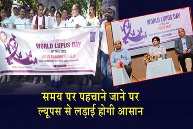 Khabar East:Early-Diagnosis-Can-Help-Battle-Lupus-Expert